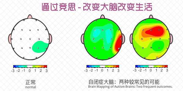 阿斯伯格綜合癥與大腦